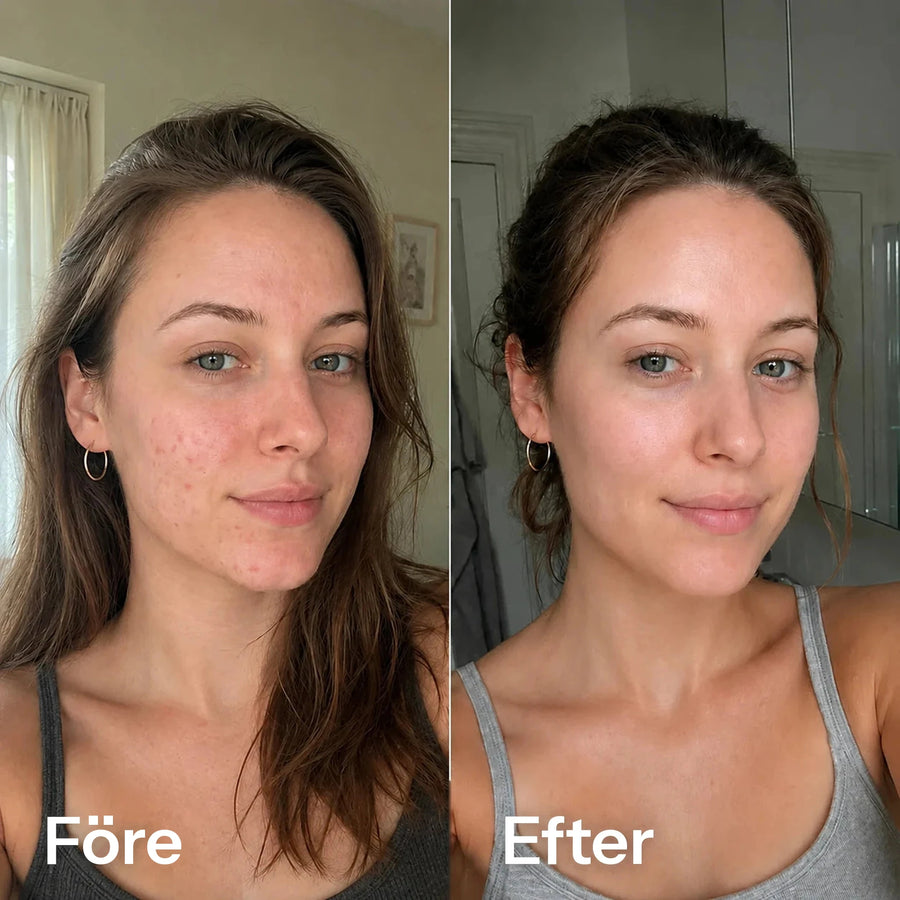 Före och efter microneedling med Feevra Microneedling Pen